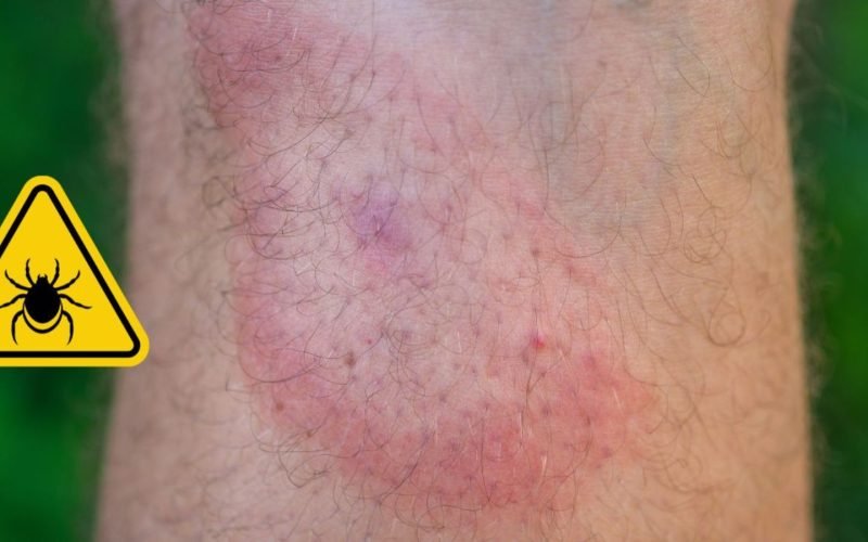What Are the Most Effective Ways to Keep Ticks Away From Kids and Pets?